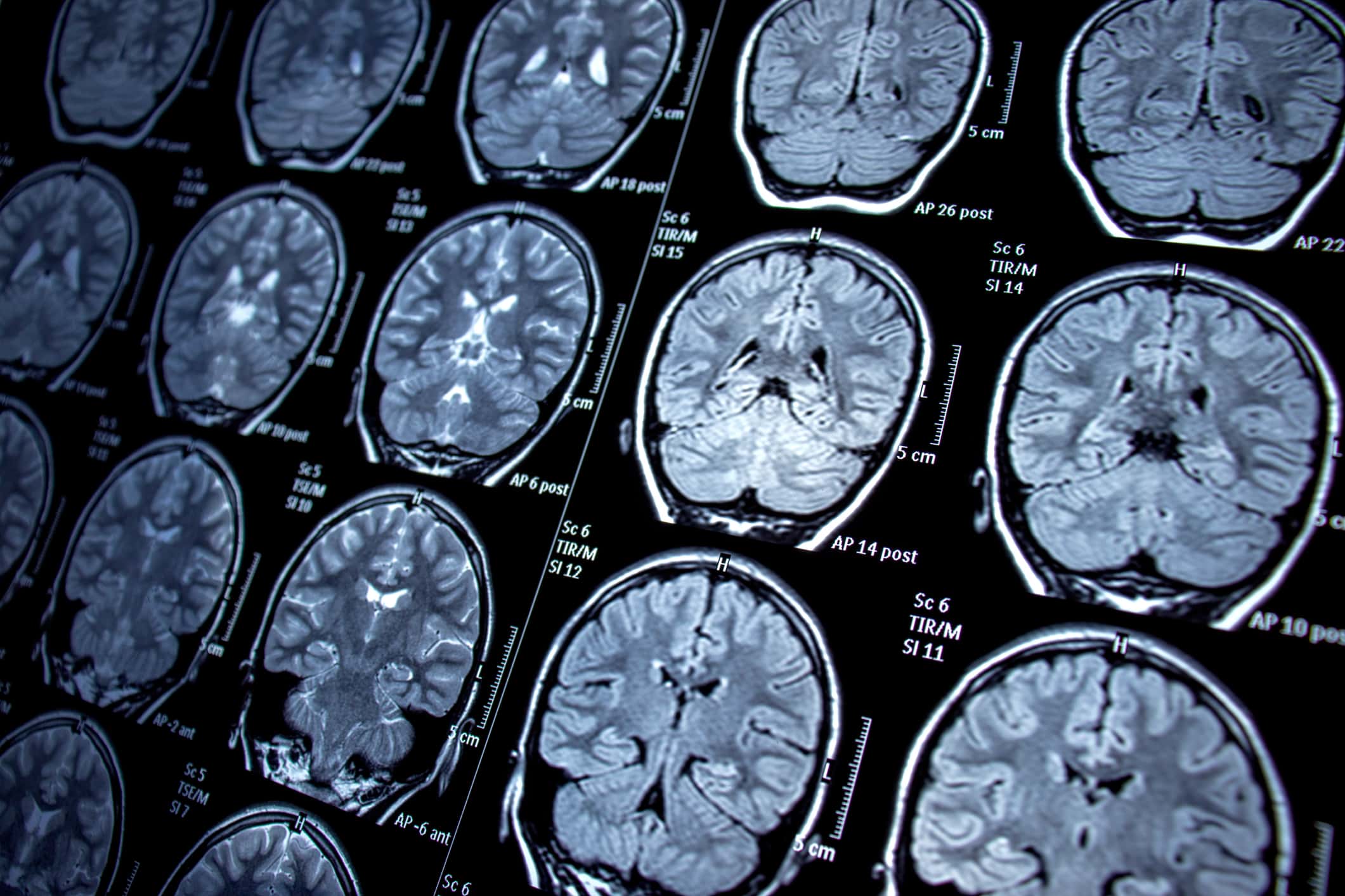 Multiple brain CT scan images arranged in rows showing cross-sectional views of the head and brain tissue.